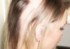 Alopecia Areata
