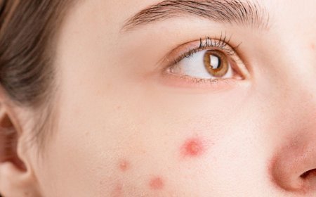 Boils and Carbuncles