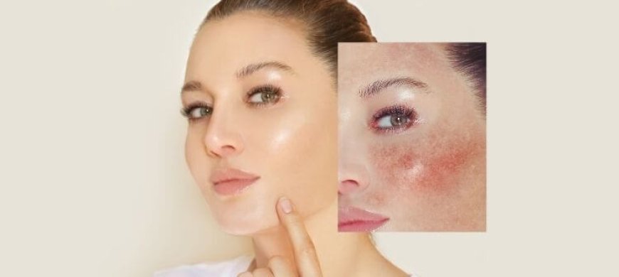 Rosacea