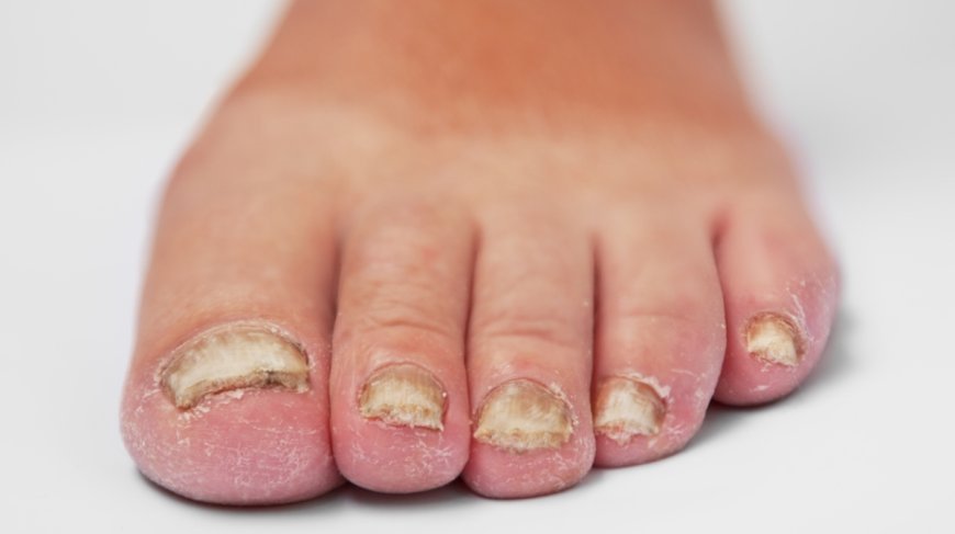 Nail Fungus