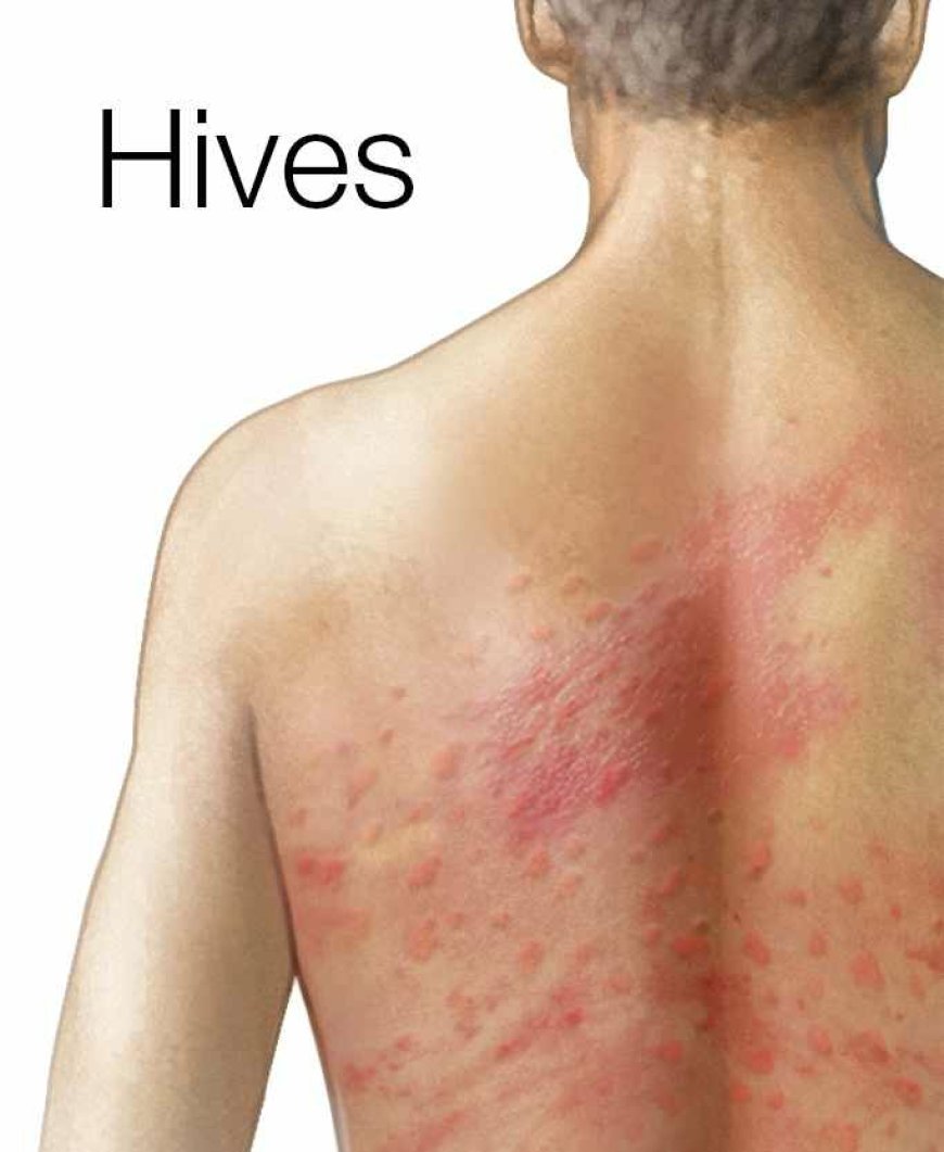 Hives