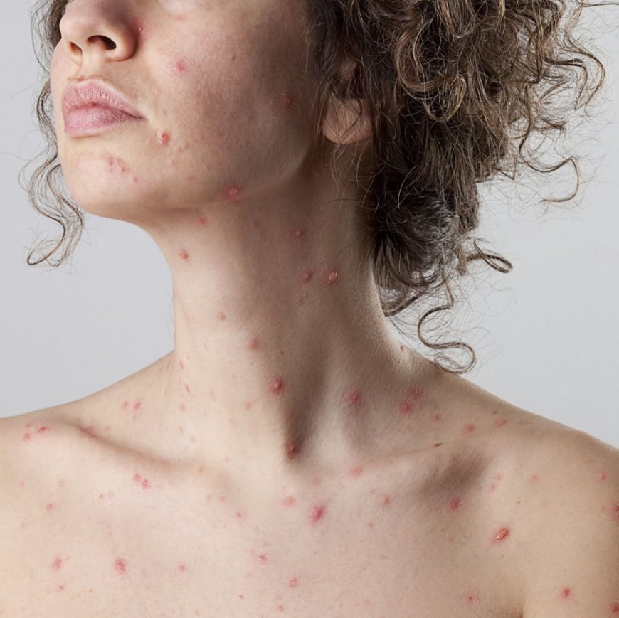 Chickenpox