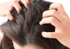 Scalp Psoriasis