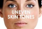 Uneven Skin Tone