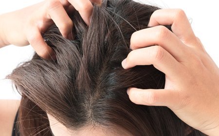Scalp Psoriasis