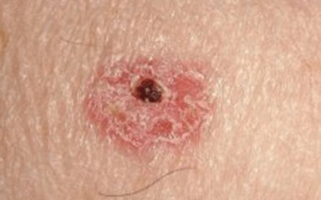 Squamous Cell Carcinoma