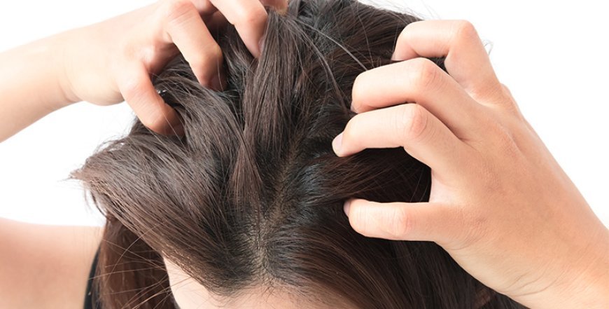 Scalp Psoriasis